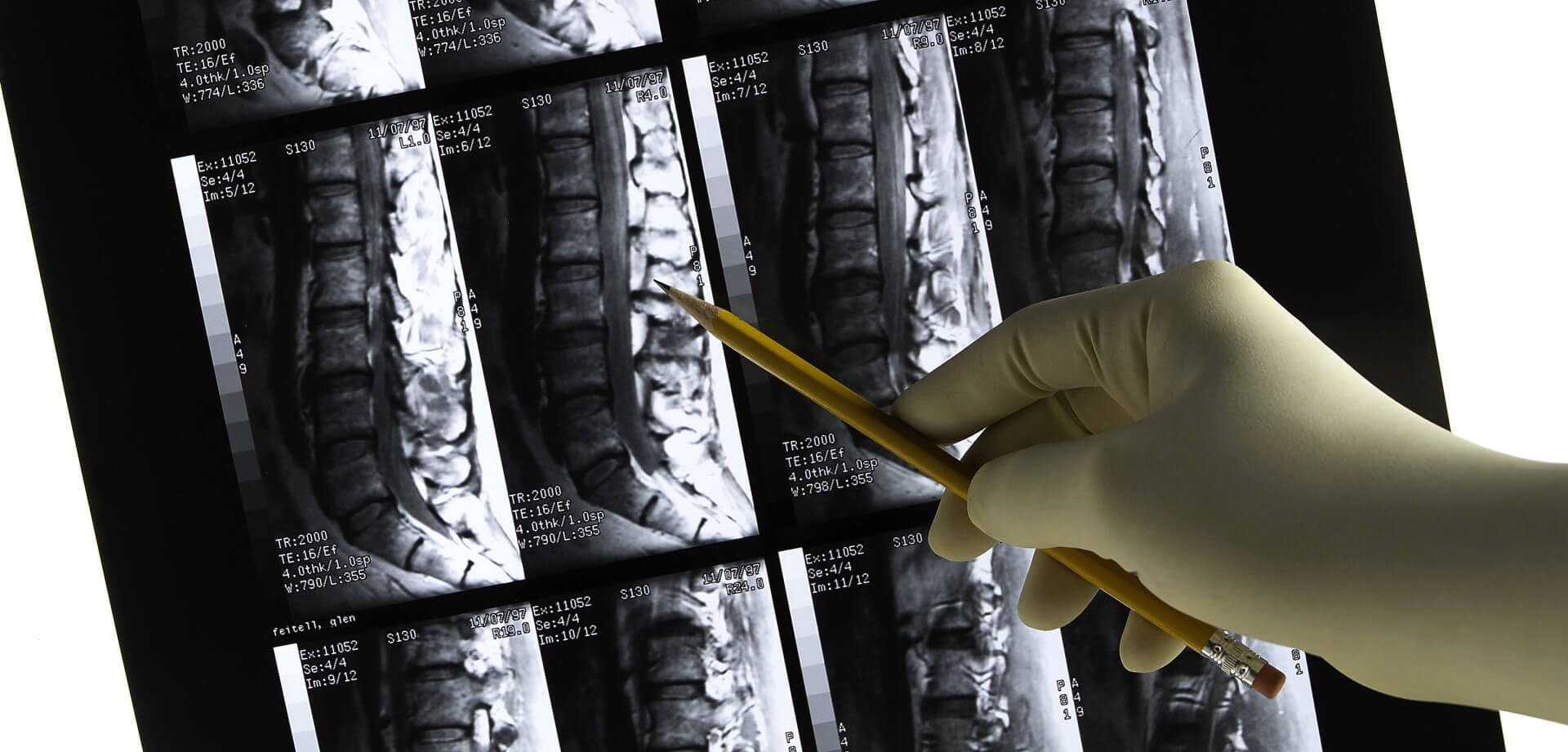 What Is a Disc Extrusion? Arnold & Itkin